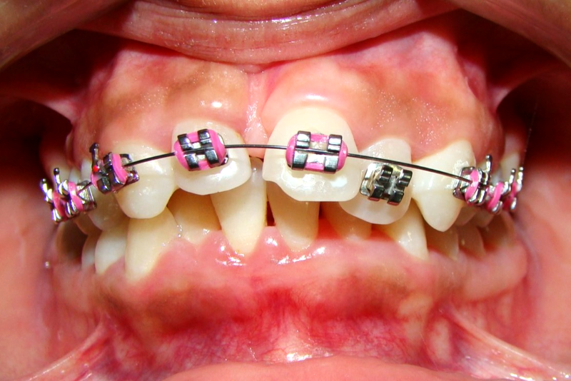 Antes do tratamento ortodôntico